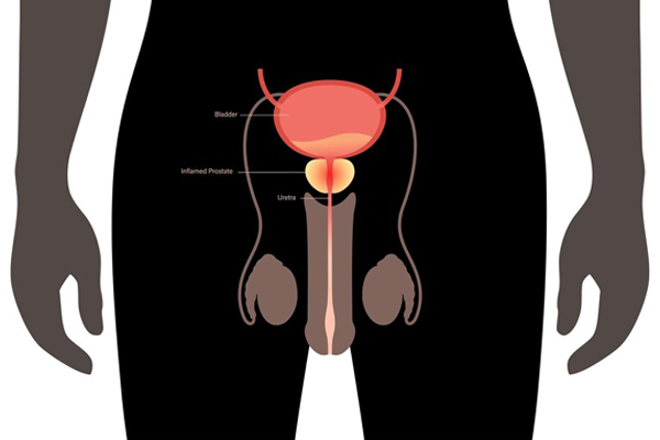 Laser Prostatectomy