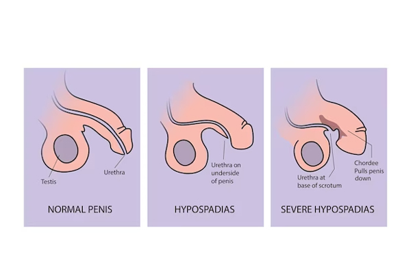 Hypospadilogy