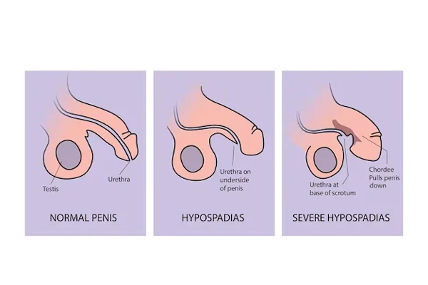 Hypospadilogy