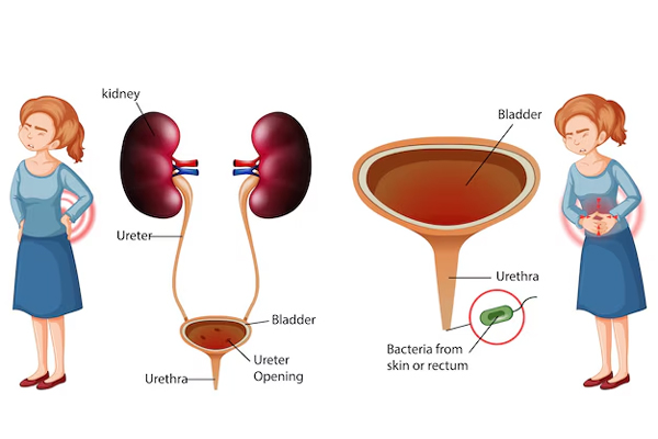 Ureter Problem